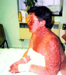 Female SJS Reaction, secondary to volterol. Severe eye involvment