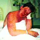 Female SJS Reaction, secondary to volterol. Severe eye involvment