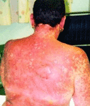 Female SJS Reaction, secondary to volterol. Severe eye involvment