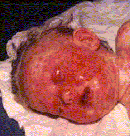 Infant with severe ocular involvement