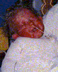 Infant with severe ocular involvement
