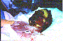 Toxic Epidermal Necrolysis