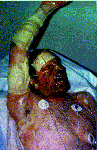 Toxic Epidermal Necrolysis (TEN) and severe ocular
involvement