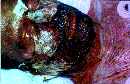 Toxic Epidermal Necrolysis