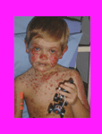 7 years old in grade 1, with SJS