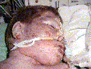 6 year old male died from TEN on May 1, 2003