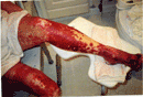 SJS Complictions with diabetes