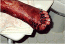 SJS Complictions with diabetes